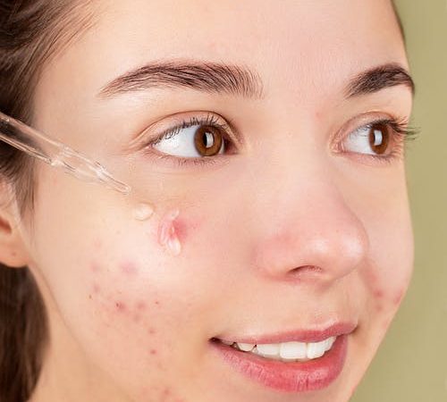 Tratamiento con láser para el acné para liberar sus cicatrices